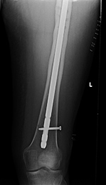 Interlocking screw backing out from the femur